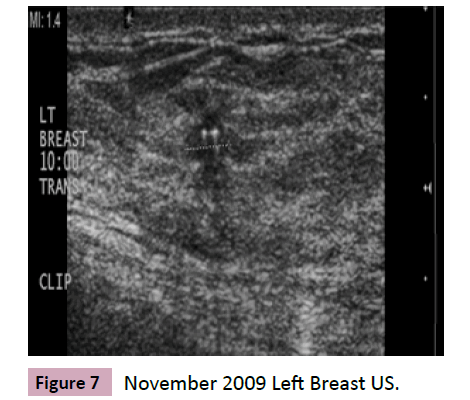 adenocarcinoma-Left-Breast