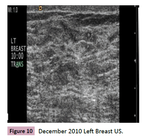 adenocarcinoma-Left-Breast