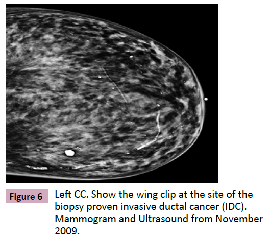 adenocarcinoma-Mammogram-Ultrasound