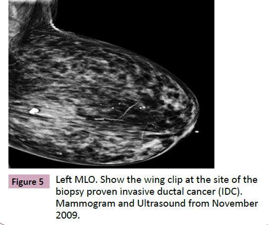 adenocarcinoma-biopsy-proven-invasive