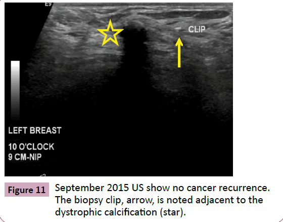 adenocarcinoma-cancer-recurrence