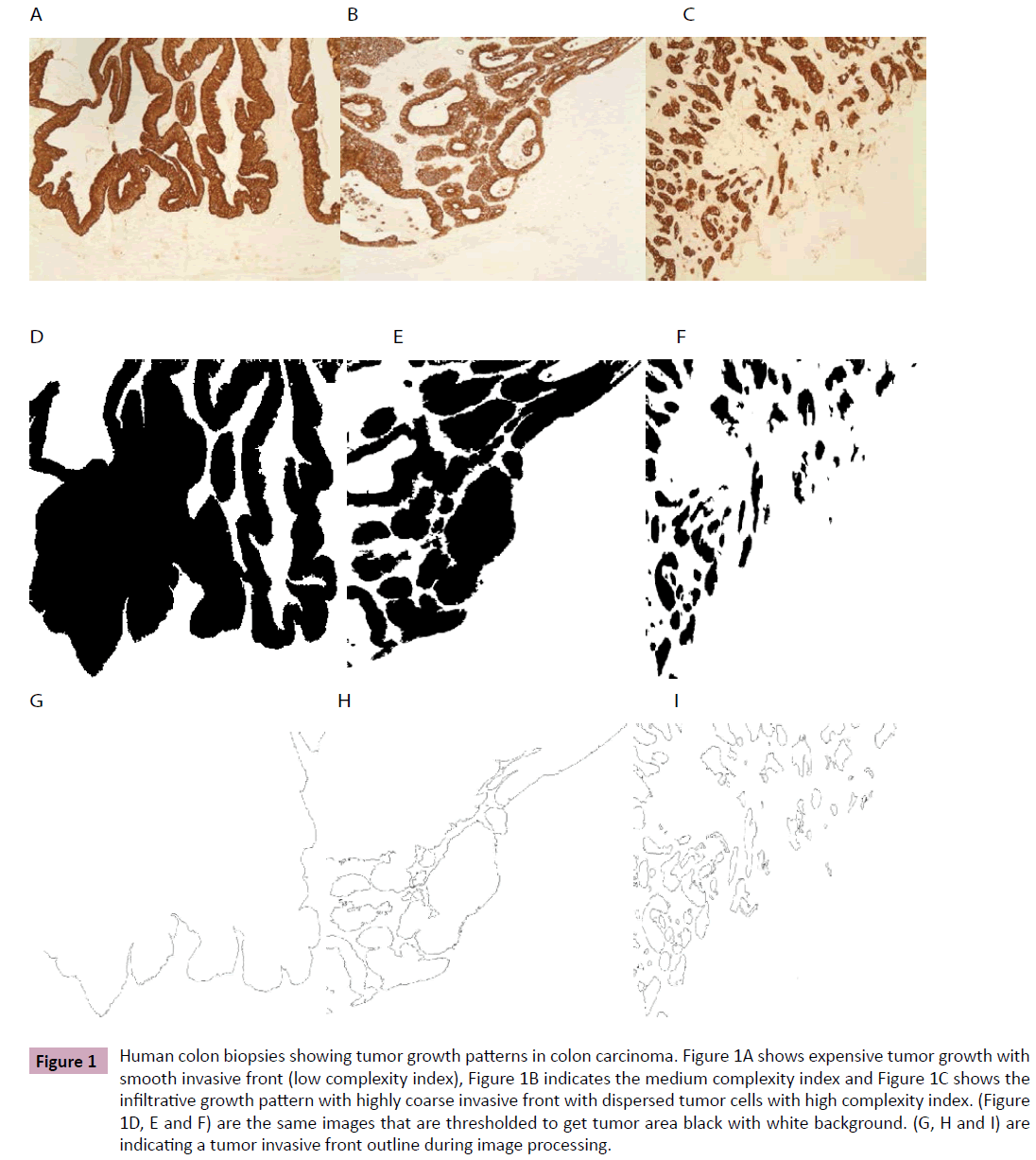 adenocarcinoma-colon-biopsies