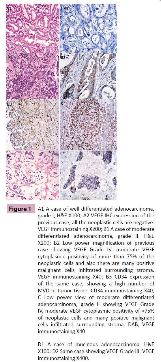 adenocarcinoma-differentiated-adenocarcinoma