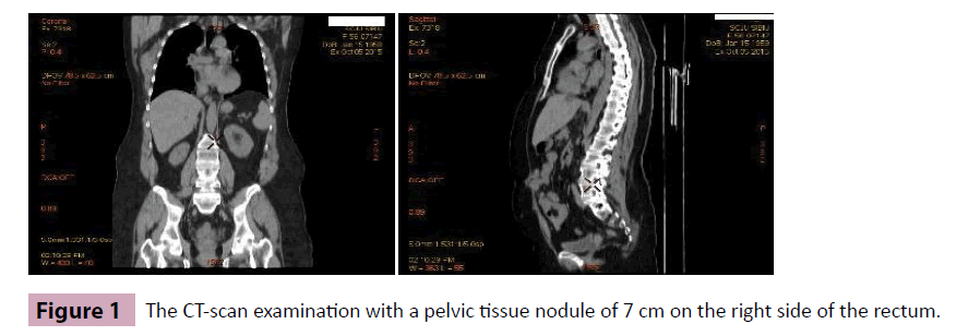 adenocarcinoma-pelvic-tissue-nodule