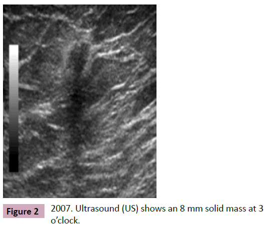 adenocarcinoma-solid-mass